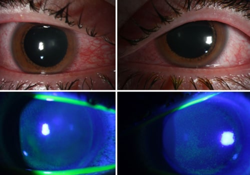 Does UV Light Give You Radiation? - An Expert's Perspective