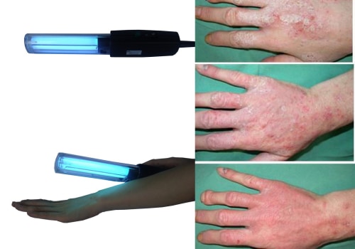 The Benefits and Risks of UV Light Therapy Explained